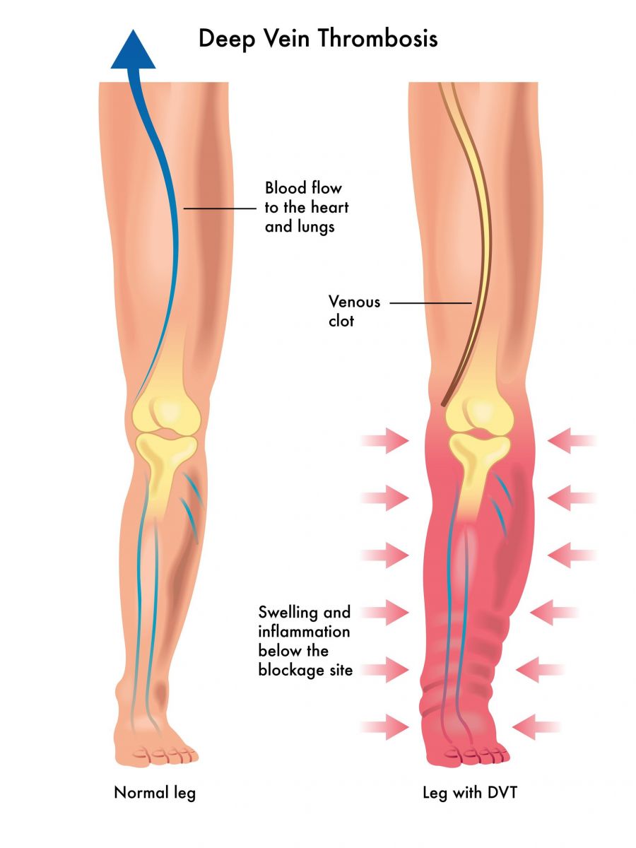 Know Your Dvt Deep Venous Thrombosis Risks Amp What To Look Out For Vein Laser Center Of New Jersey